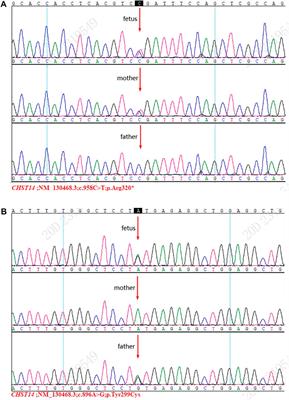 Case Report: A Novel Mutation Identified in CHST14 Gene in a Fetus With Structural Abnormalities